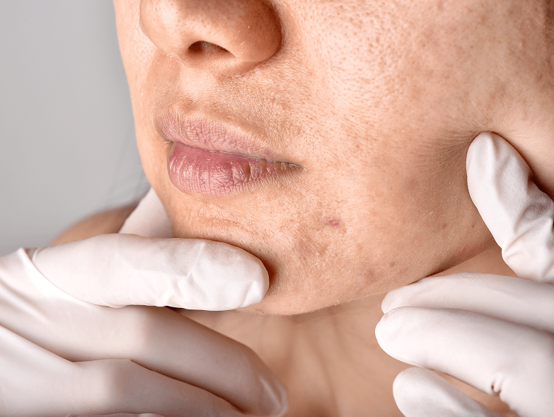 Белези от акне | Естетична дерматология в Hill Clinic