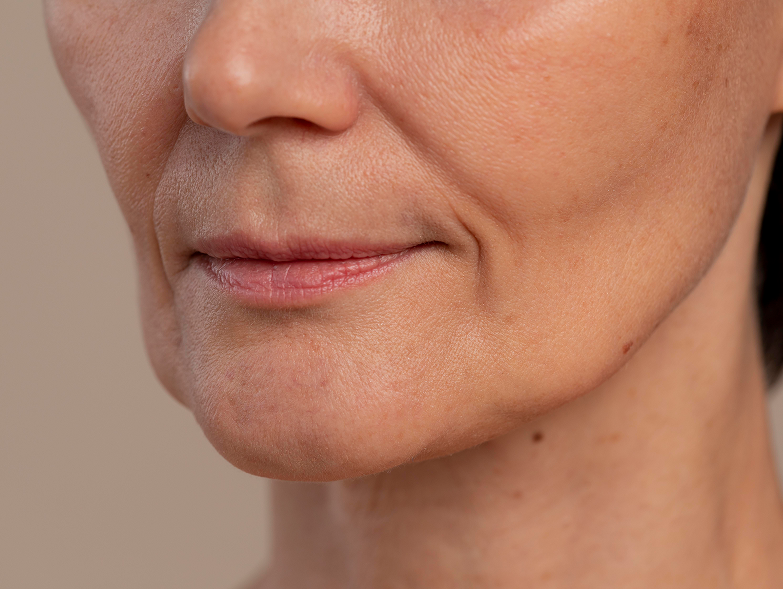 Бръчки около устните | Естетична дерматология в Hill Clinic