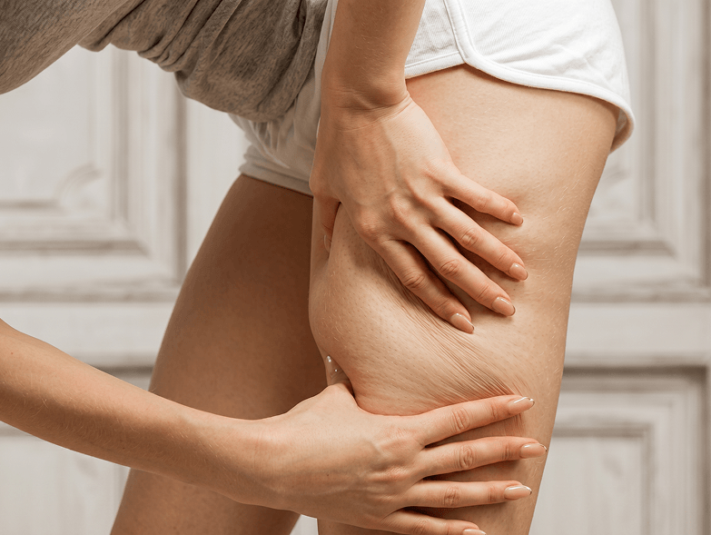 Задържане на течности | Естетична дерматология в Hill Clinic